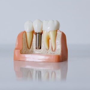 Implantes dentales en Terrassa - precios implantes dentales 300x300