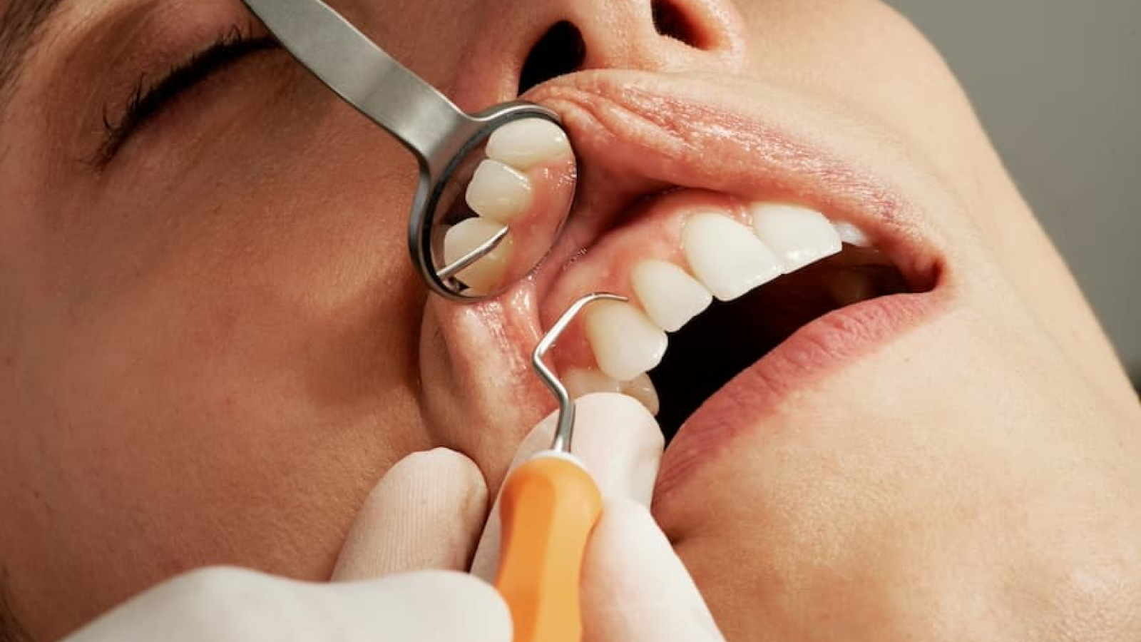 sintomas gingivitis periodontitis