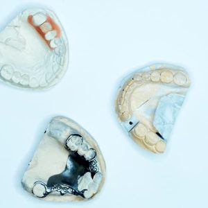 Ortodoncia en Terrassa - mantenedores espacios dentales para que sirven 300x300