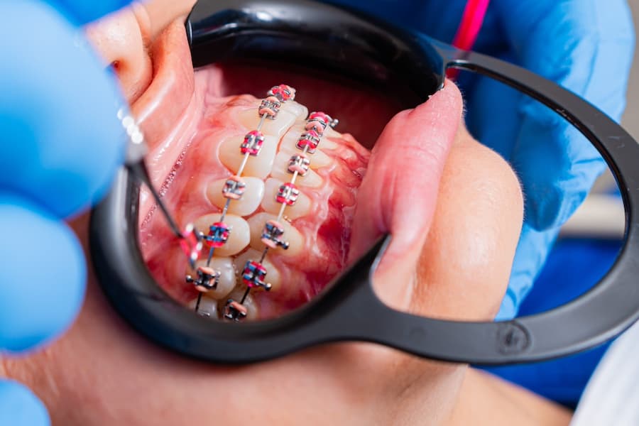 Blog - que es ortodoncia estetica