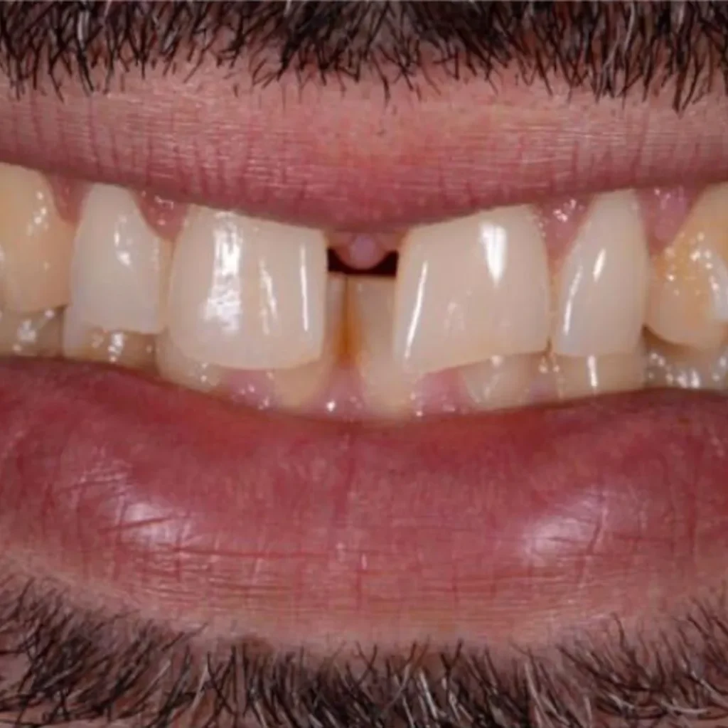 Ortodoncia en Terrassa - 4 1 1024x1024