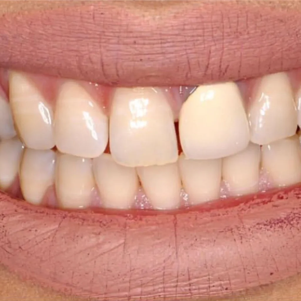 Pr&oacute;tesis dental en Terrassa - 6 1 1024x1024