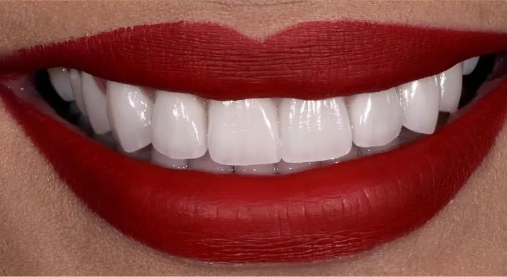 Pr&oacute;tesis dental en Terrassa - 6 2 1024x560