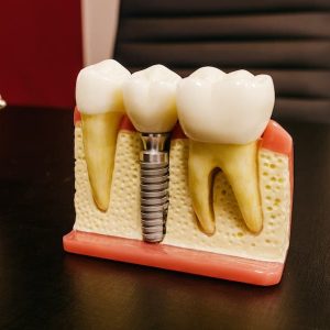 Implantes dentales en Terrassa - que son implantes dentales 300x300