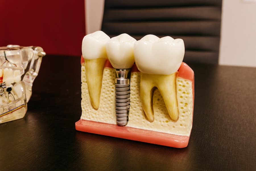 Blog - que son implantes dentales