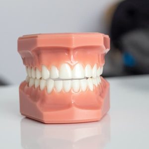 Odontopediatr&iacute;a en Terrassa - paladar estrecho 300x300