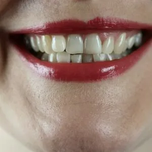 Carillas dentales en Terrassa - por que tengo los dientes amarillos 300x300