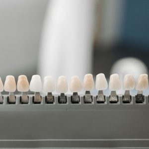 Implantes dentales en Terrassa - aumento de la dimension vertical dental 300x300