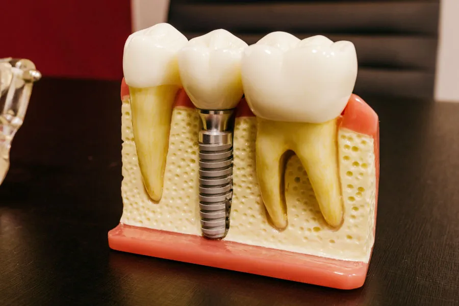 Implantes dentales en Terrassa - Implantes dentales en Terrassa 4
