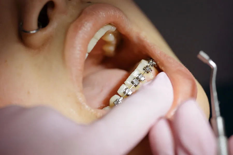 Ortodoncia en Terrassa - Ortodoncia en Terrassa 3