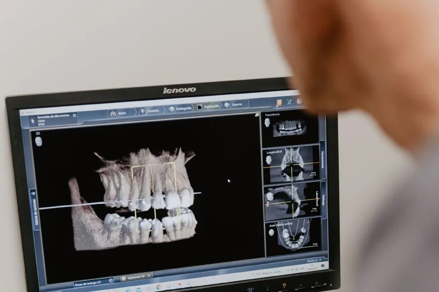 Pr&oacute;tesis dental en Terrassa - Protesis dental en Terrassa 10