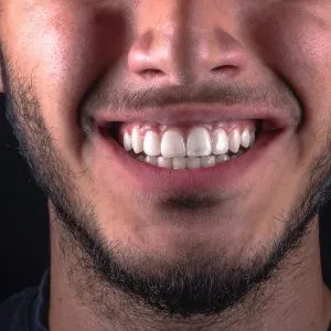 Implantes dentales en Terrassa - que son los puentes dentales 300x300