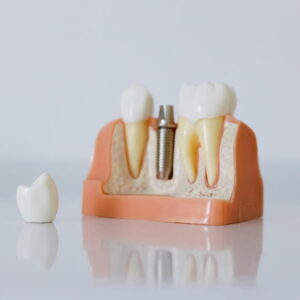 Periodoncia en Terrassa - prevenir periimplantitis 300x300