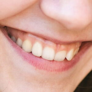 Est&eacute;tica dental en Terrassa - sonrisa gingival 300x300