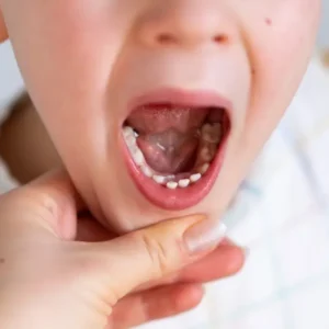 Odontopediatr&iacute;a en Terrassa - frenillo lingual 2025 300x300