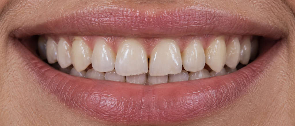 Carillas dentales en Terrassa - carillas antes